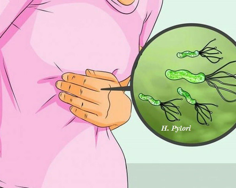 Диагностика Хеликобактер (H.pylori)