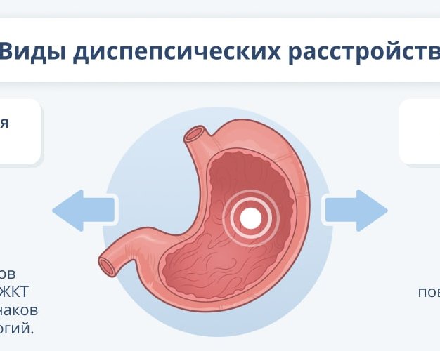 Функциональная диспепсия