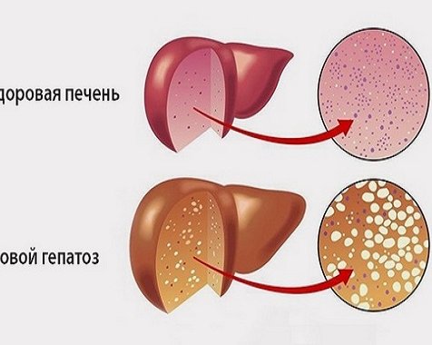 Что такое ожирение печени