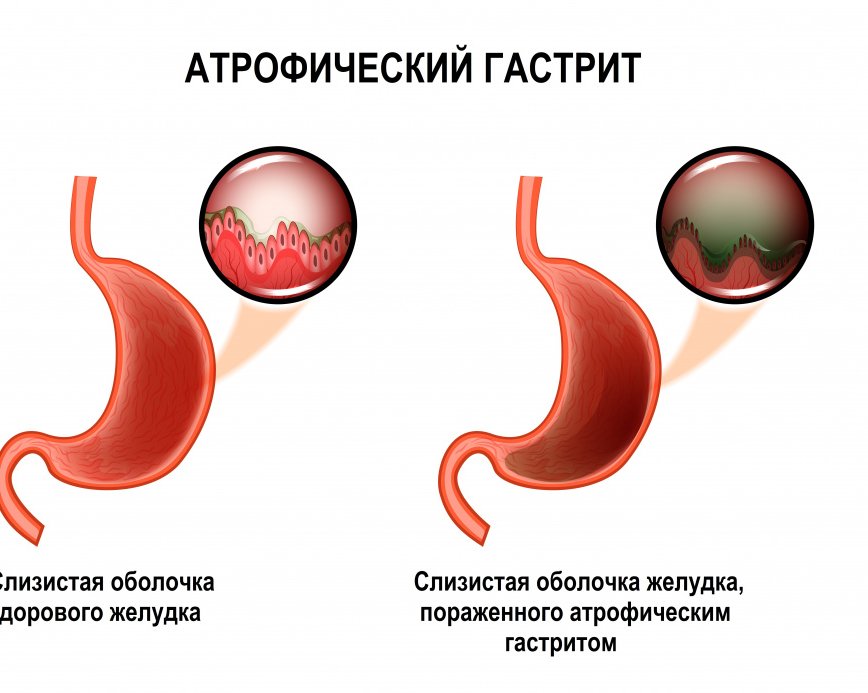 Атрофический гастрит - редкая болезнь?