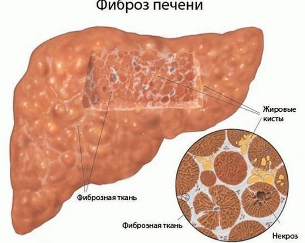 Профилактика фиброза печени